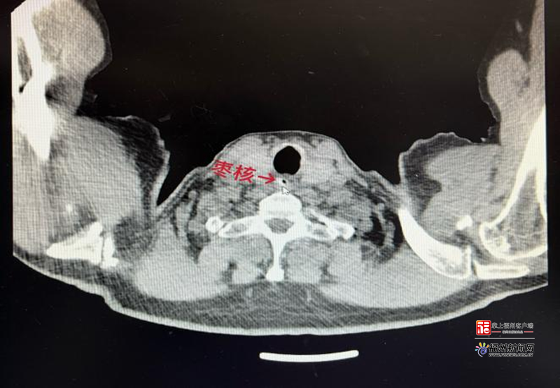 好医声｜七旬老人被卡喉！医生紧急提醒：元宵这些“甜蜜风险”要当心