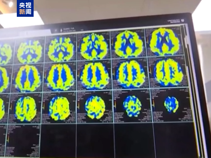 首款侵入式脑机接口医疗器械获批上市 首款侵入式脑机接口医疗器械获批上市