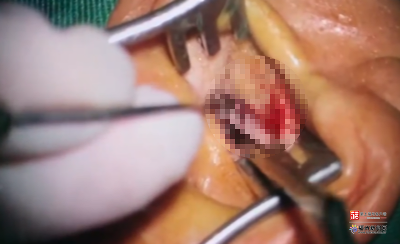 好医声|老人耳道藏70余条蛆 医生提醒:乱掏耳朵隐患大 好医声|老人耳道藏70余条蛆 医生提醒:乱掏耳朵隐患大