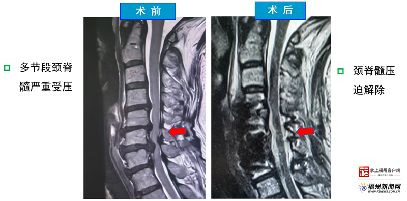 好医声｜福州老太走路如踩棉花 竟是“钳夹型颈椎病”作祟
